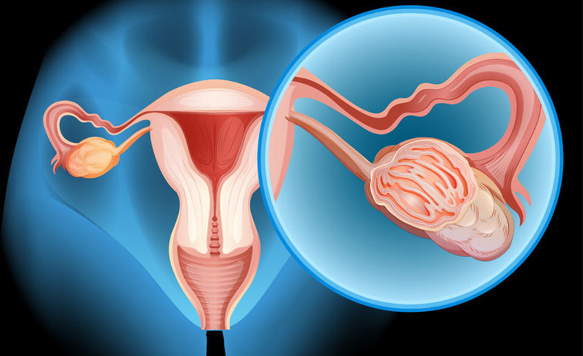 שחלות פוליציסטיות - polycystic ovaries